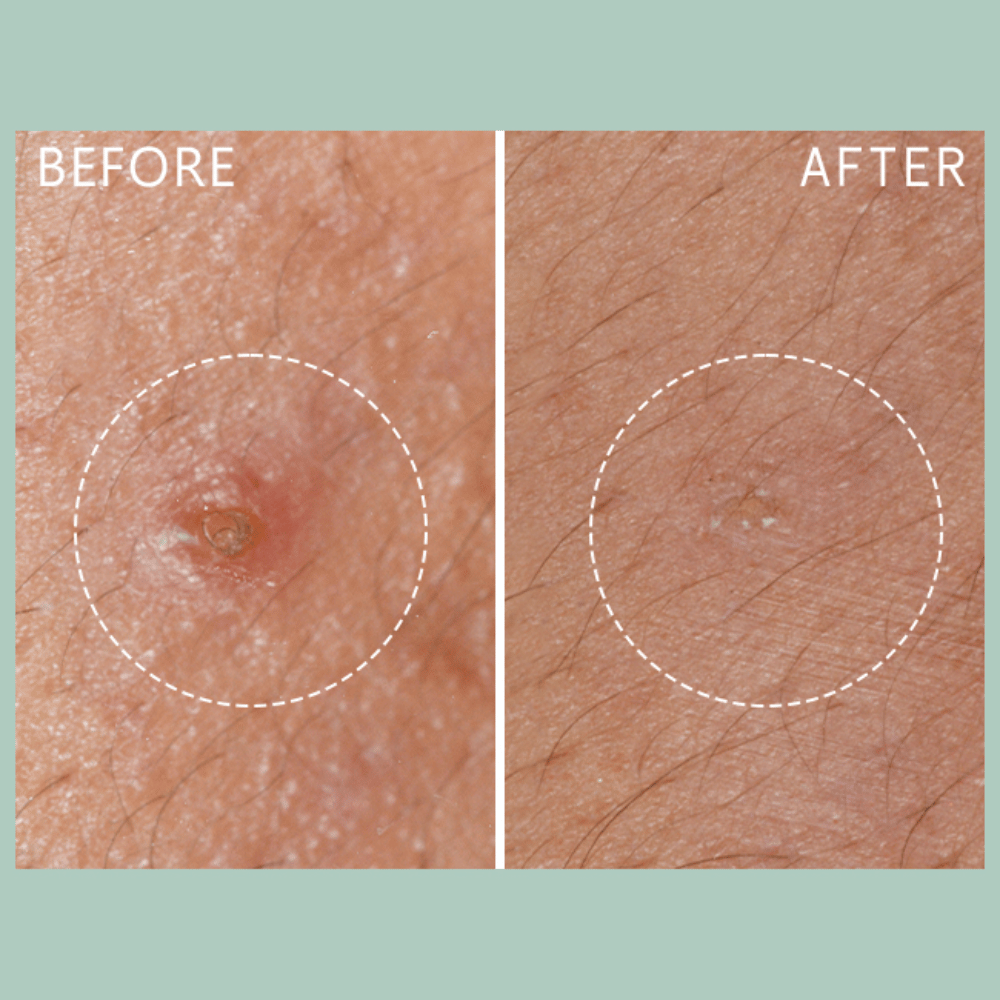 Lierac Anti-Blemish Protocol The Stop Spots 15ml
